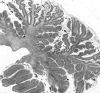 Multiple cavernous  malformations, familial, cerebellum (whole mount)